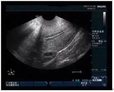 高龄多囊卵巢做供卵试管：三代PGT技术如何实现优生与性别选择